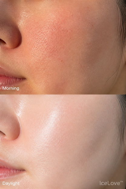 Ice Roller IceLove — Pores resserrés en 2 minutes